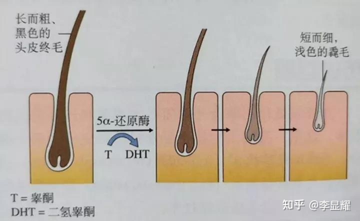 肾虚脱发 脂溢 区别_女性脂溢脱发图片_脂溢性脱发偏方