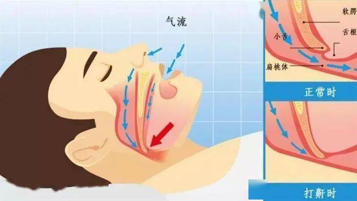 老偏方治疗灰指甲偏方_打呼噜治疗偏方_治疗打鼻鼾偏方