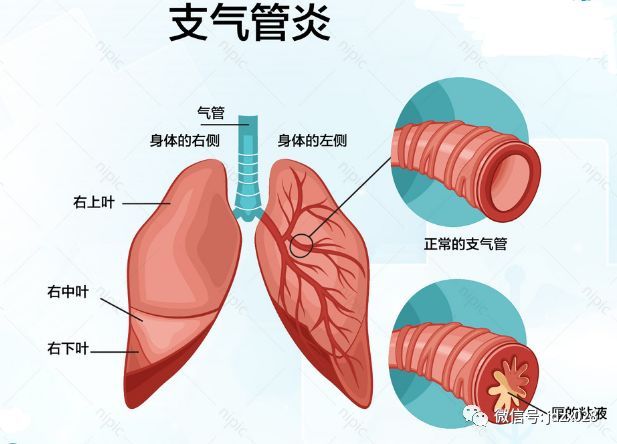 咳嗽性哮喘的偏方_鼻子过敏眼睛痒偏方_过敏性咳嗽偏方