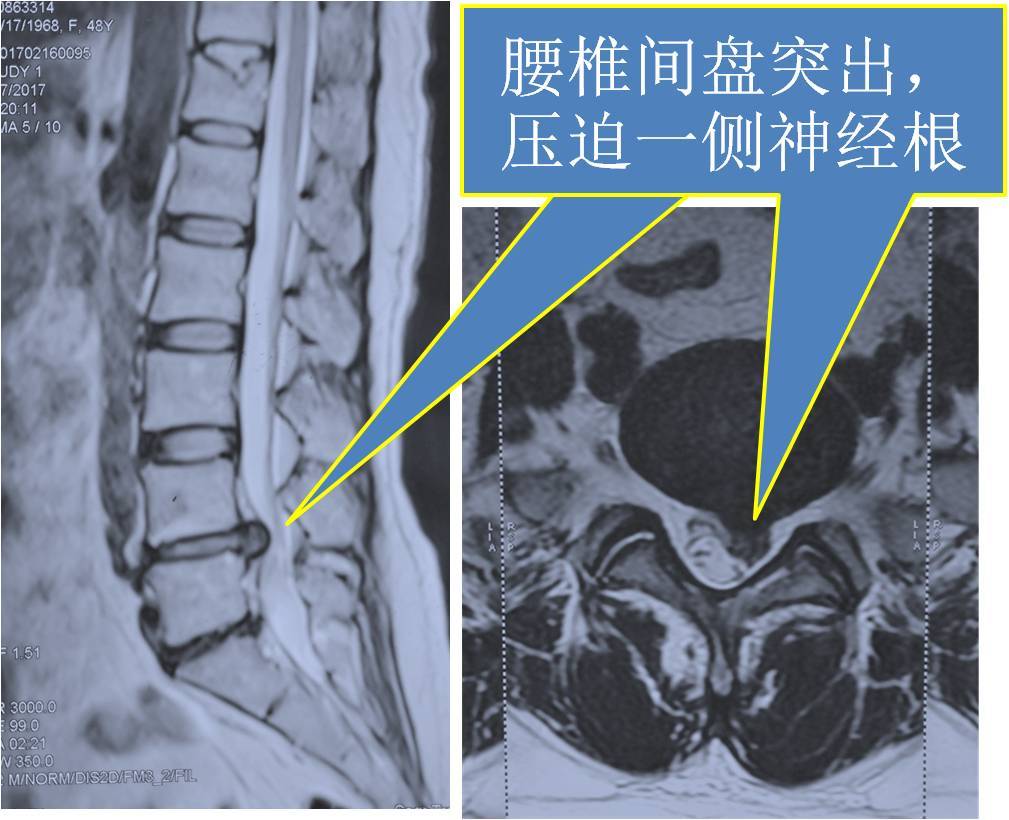 腰间突出怎么治疗_治疗腰间盘突出偏方_腰间突出的治疗偏方