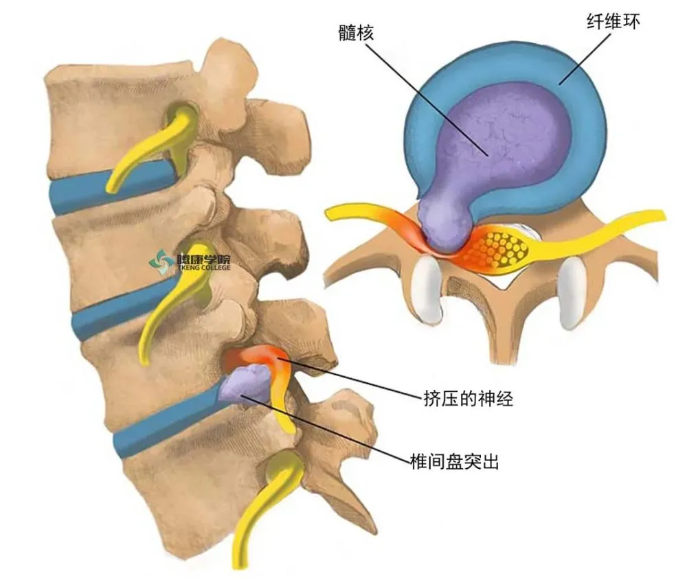 哮喘断根秘方_千家妙方治荨麻疹断根秘方_腰椎间盘特效断根秘方