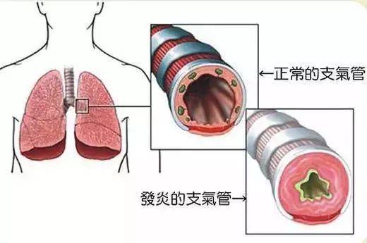 治疗咳嗽的小偏方_过敏性咳嗽治疗偏方_治疗宝宝咳嗽偏方