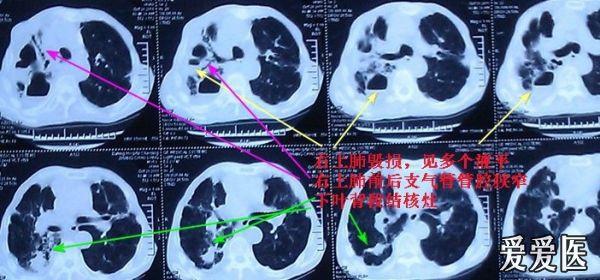 治疗宝宝咳嗽偏方_过敏性咳嗽治疗偏方_治疗咳嗽的小偏方