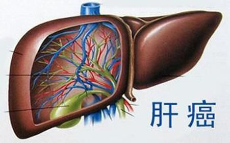 治疗肝癌晚期的偏方_肝癌晚期中药偏方真实_肝癌晚期黄疸高有什么偏方吗