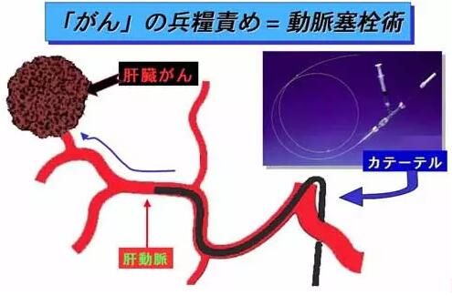 治疗肝癌晚期的偏方_肝癌晚期中药偏方真实_肝癌晚期黄疸高有什么偏方吗