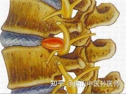 小孩烫伤治好后有点增生用什么药好_骨髓增生异常综合征中医证治_天下一绝治骨质增生