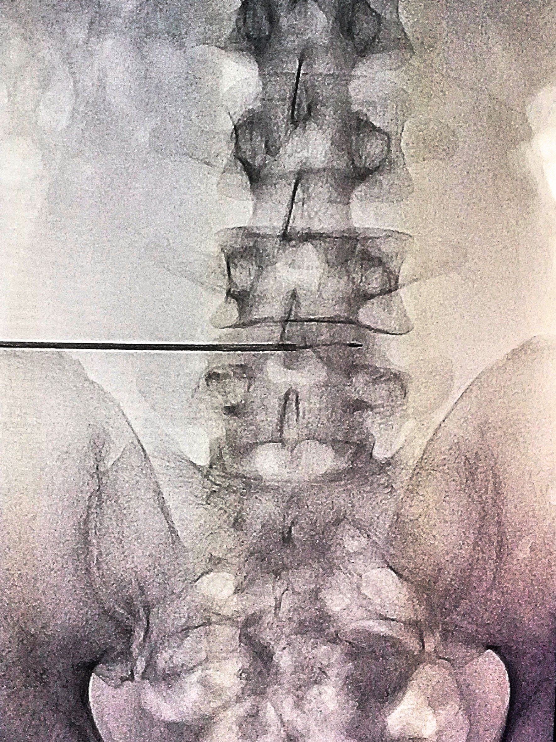 腰间椎盘突出症治疗_腰椎间盘突出症的治疗偏方_治疗腰椎间盘突出症的中药偏方