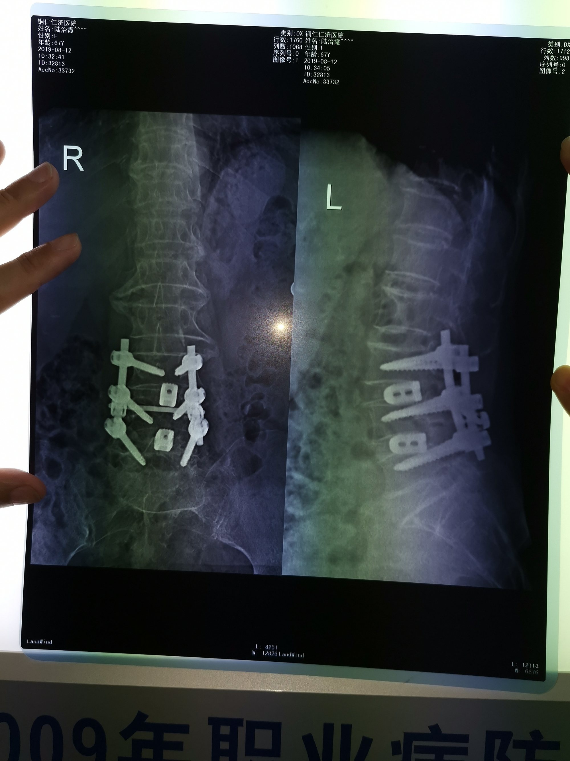 治疗腰椎间盘突出症的中药偏方_腰椎间盘突出症的治疗偏方_腰间椎盘突出症治疗