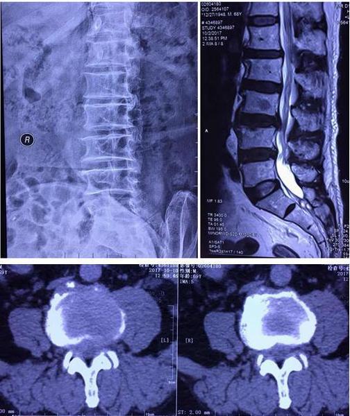 腰椎间盘突出症的治疗偏方_腰间椎盘突出症治疗_治疗腰椎间盘突出症的中药偏方