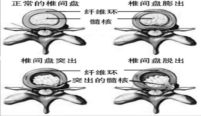 治腰椎间盘突出秘方_神奇膏药秘方治腰椎间盘突出_治淋巴结的神奇秘方