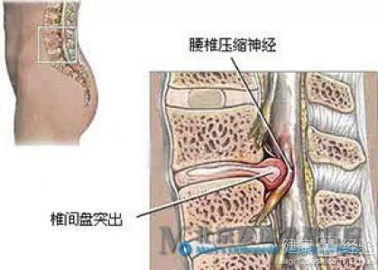 神奇膏药秘方治腰椎间盘突出_治腰椎间盘突出秘方_治淋巴结的神奇秘方