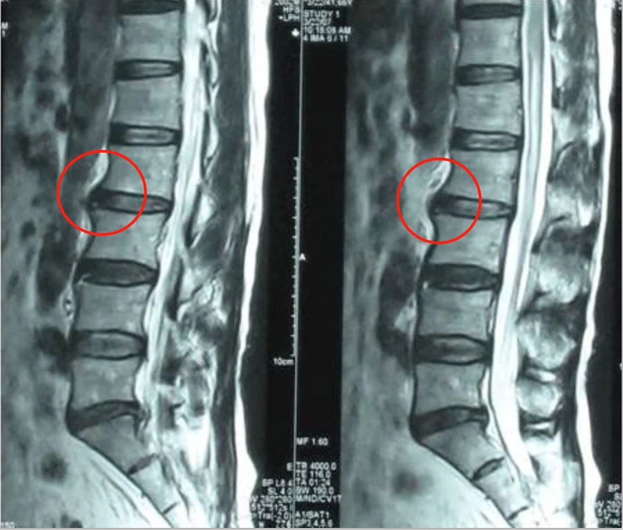 治淋巴结的神奇秘方_神奇膏药秘方治腰椎间盘突出_治腰椎间盘突出秘方