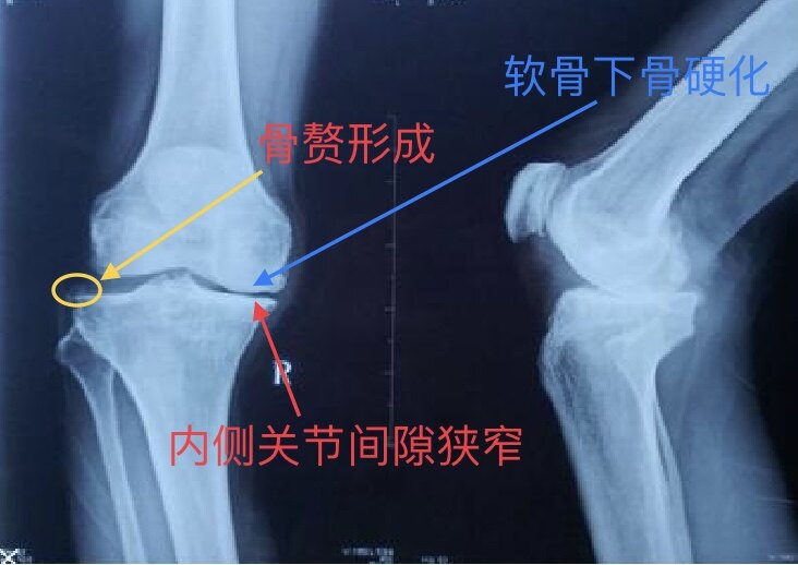 根治各种膝关节病偏方