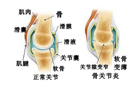 内在因素:慢性膝关节滑膜炎一般由急性创伤性膝关节膝关节滑膜炎失治
