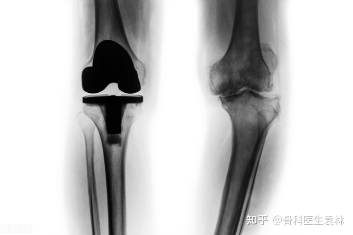 关节炎偏方_类风湿性关节炎的偏方_治疗关节炎的偏方