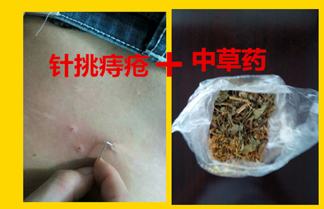 有偏方治痔疮吗_小偏方有效治痔疮_治痔疮的偏方有效吗