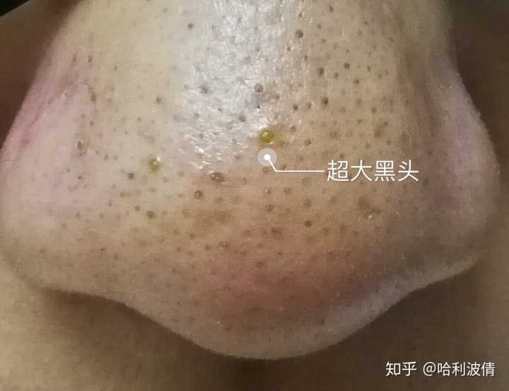 眼部扁平疣去除的偏方_眼部脂肪粒去除偏方_去除眼部皱纹的偏方