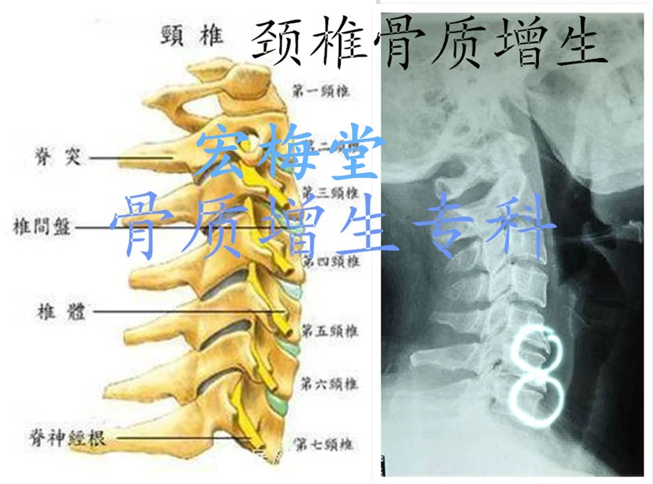 治疗颈椎骨质增生药_颈椎骨质增生偏方_骨质增生的12偏方 民间