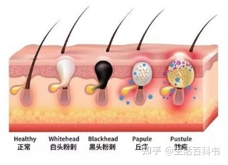 治疗粉刺痤疮的中医_上海痤疮中医治疗医院_中医治疗痤疮