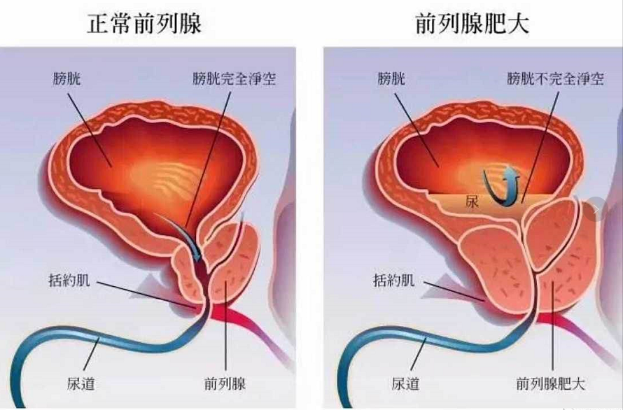 如何刺激前列 腺 知乎_前列腺增生土方治疗_前列脉增生治疗方法