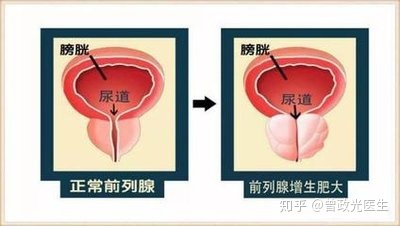 前列脉增生治疗方法_前列腺增生土方治疗_如何刺激前列 腺 知乎