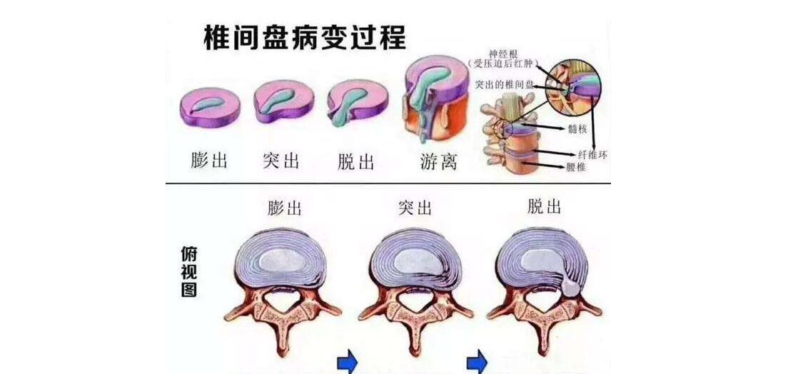 预防腰间椎盘突出_腰间突出 中医治疗_腰间盘突出小偏方