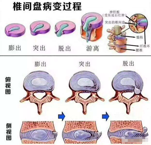 预防腰间椎盘突出_腰间盘突出小偏方_腰间突出 中医治疗