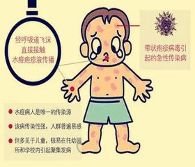 水痘的传染期_出水痘传染吗_小孩起水痘传染吗