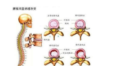民间几种根治腰椎间盘突出的偏方，一个月就能彻底治愈，太神奇！