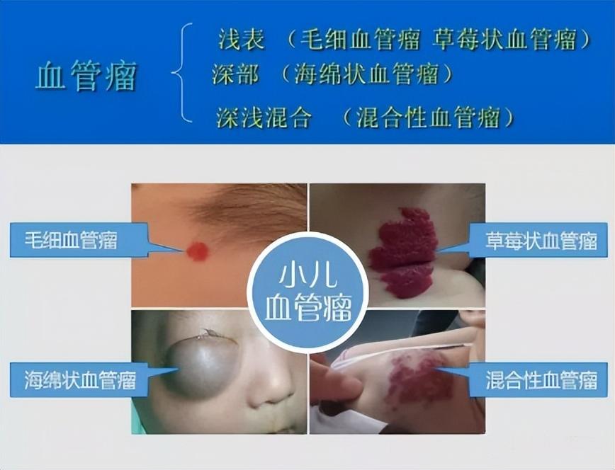 血管瘤毛细血管扩张好治愈吗_毛细血管瘤_血管瘤毛细血管扩张