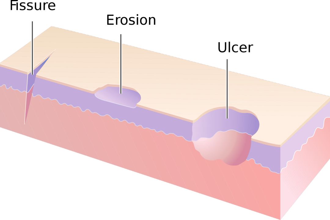 性溃疡_结核性溃疡_穿透性溃疡