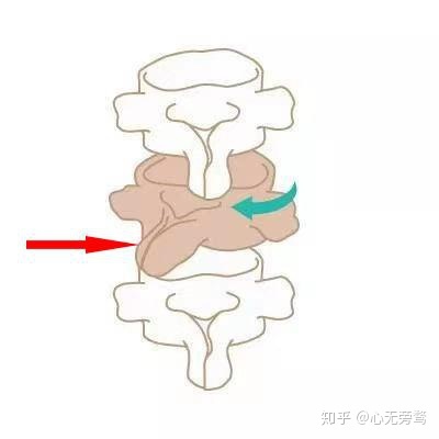 腰椎肩盘突出怎么治疗_腰椎间盘突出症的治疗偏方_虎杖治疗腰椎突出症做法