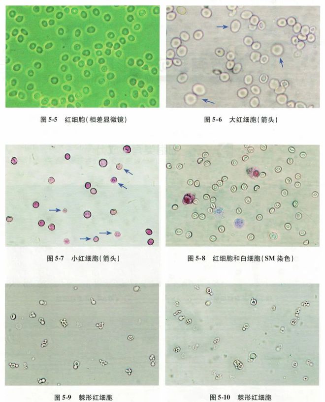 血尿的原因_血尿可能原因_血尿因为什么