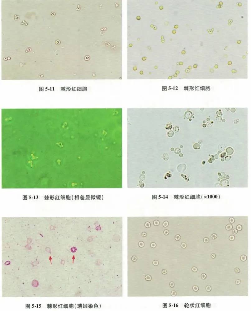 血尿因为什么_血尿的原因_血尿可能原因