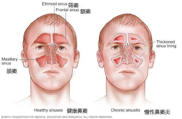 鼻炎治疗费用大概是多少_鼻炎治疗药物_治疗鼻炎