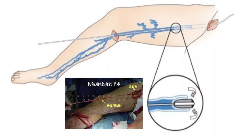 生姜擦腿治疗静脉曲张偏方_生姜对静脉曲张有用吗_生姜放脚底对静脉曲张有帮助么