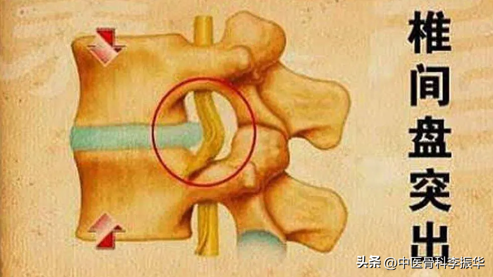 腰椎间盘突出特效秘方_腰椎肩盘突出2/33/4怎么治疗_腰椎肩盘突出素