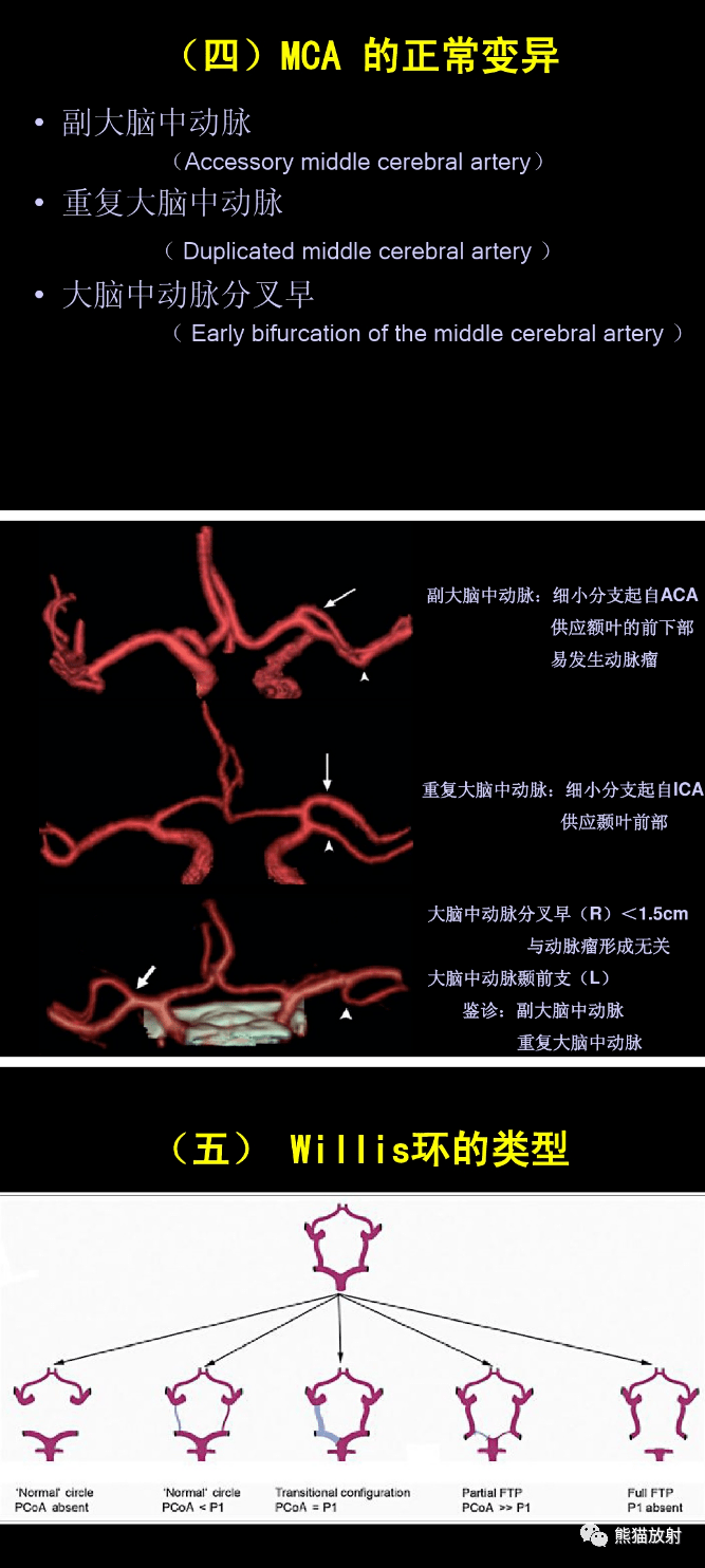 随着脑动脉硬化病变的发展,脑小动脉的血管壁普遍增厚,管腔狭窄,产生