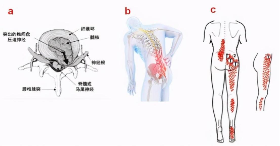 腰椎肩盘突出怎么治疗_农村土偏方治腰椎间盘突出_治腰椎间盘突出偏方