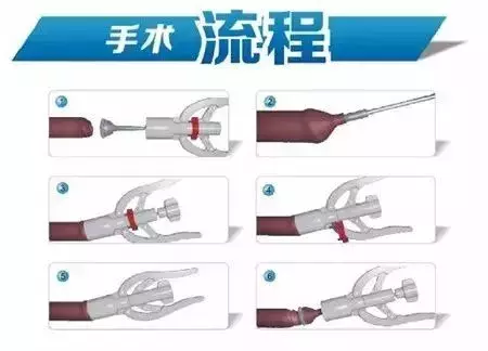 新津县人民医院可以做包皮手术吗_杭州下沙可以做包皮手术吗_包皮手术后多久可以同房