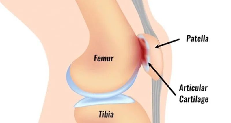 髌股关节炎的病因、诊断与康复治疗方法