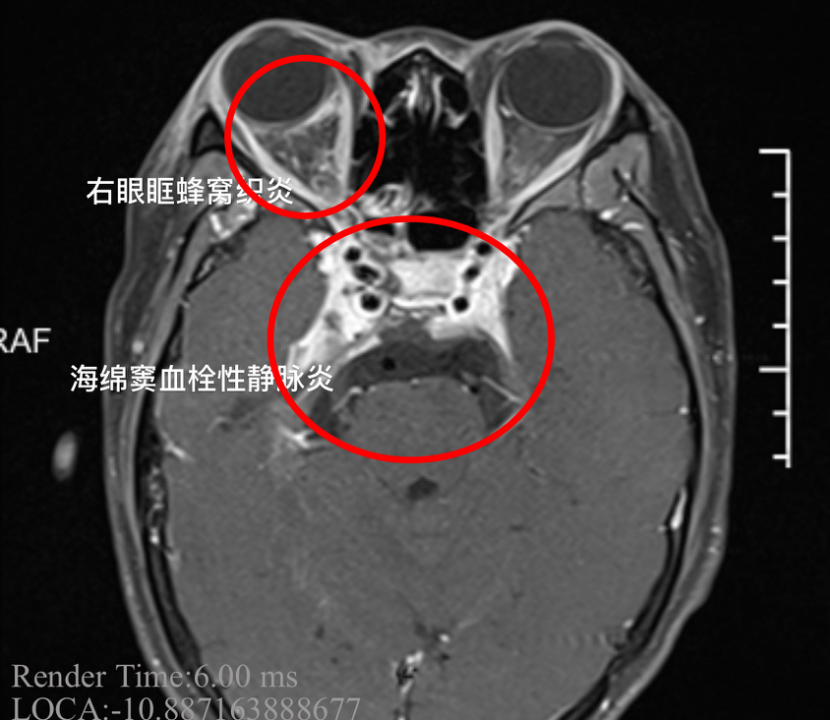 南京高校联盟窦窦照片_乙状窦血栓_海绵窦血栓