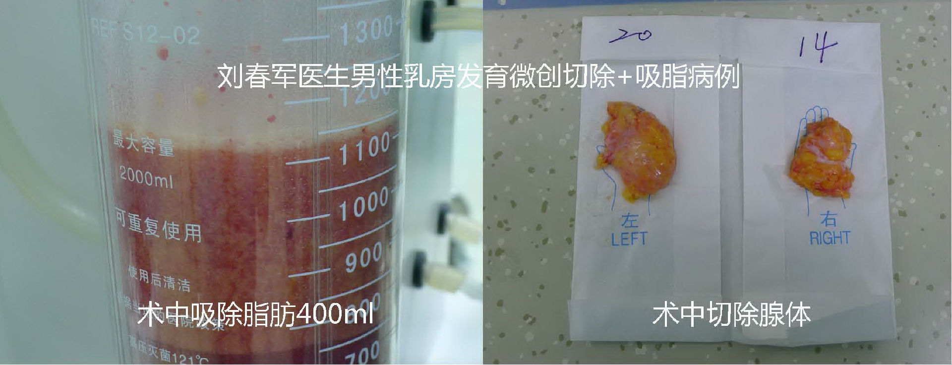 老年阴炎中医治疗偏方_sitebaojian.91jm.com 乳腺贴能治疗乳腺_治疗乳腺炎的偏方