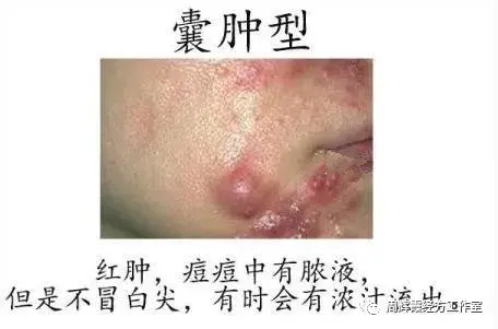 100种常见病的症状_热毒型痤疮是什么症状_聚合性痤疮怎么治