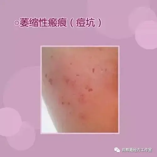 聚合性痤疮怎么治_100种常见病的症状_热毒型痤疮是什么症状