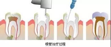 补牙后吃东西有点痛正常吗_补牙封药后疼正常吗_补牙后牙齿酸痛正常吗