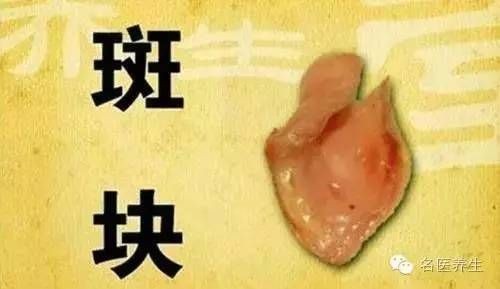 血管壁清理干净的有效方子_血管壁清理视频_