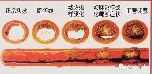 血管壁清理视频__血管壁清理干净的有效方子