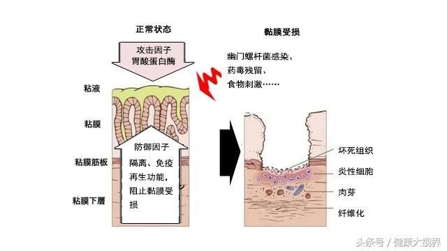 慢性胃炎，根在“自愈力”，中医“养胃方”，快速痊愈！