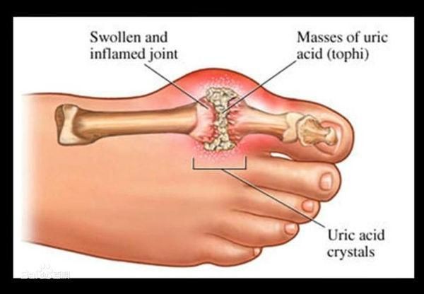 治痛风降尿酸的中药方__痛风降尿酸中药配方
